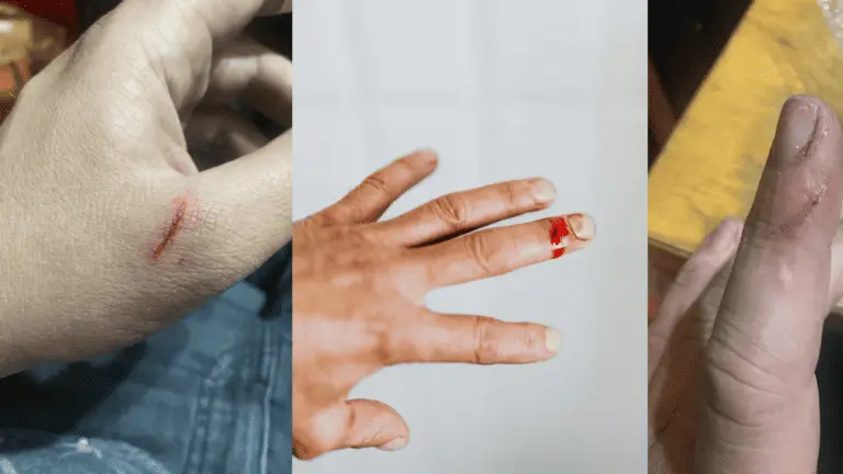 How to Treat a Paper Cut
